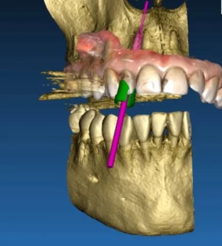 Niejasny problem z zębami tomografia komputerowa zębów Warszawa