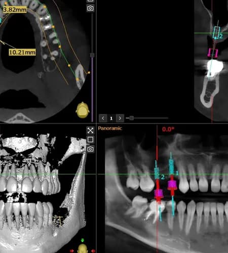 Niejasny problem z zębami tomografia komputerowa zębów Warszawa