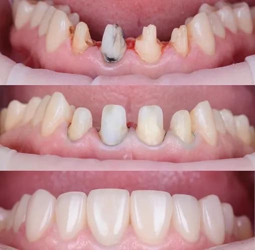 Керамічні вініри для ідеальної посмішки у Варшаві