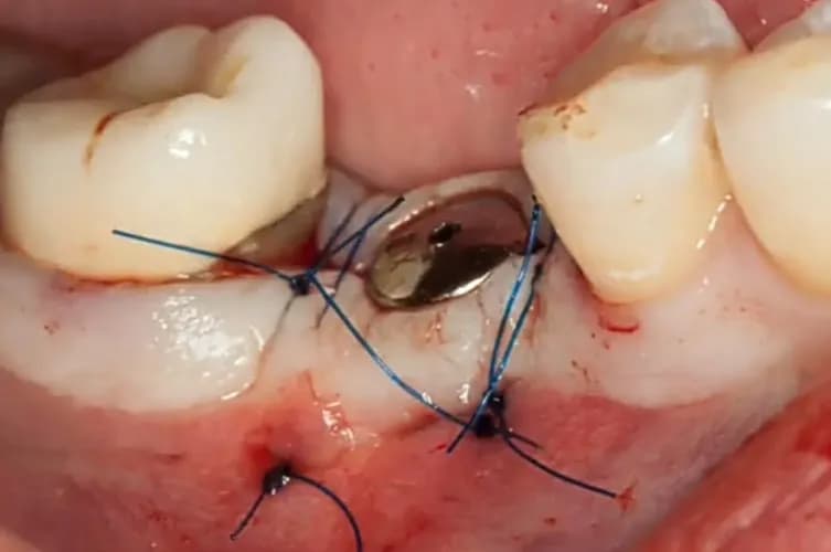 Імплант зуба з коронкою – повне відновлення у Варшаві