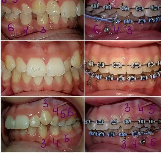 Встановлення брекетів для вирівнювання зубів у Варшаві