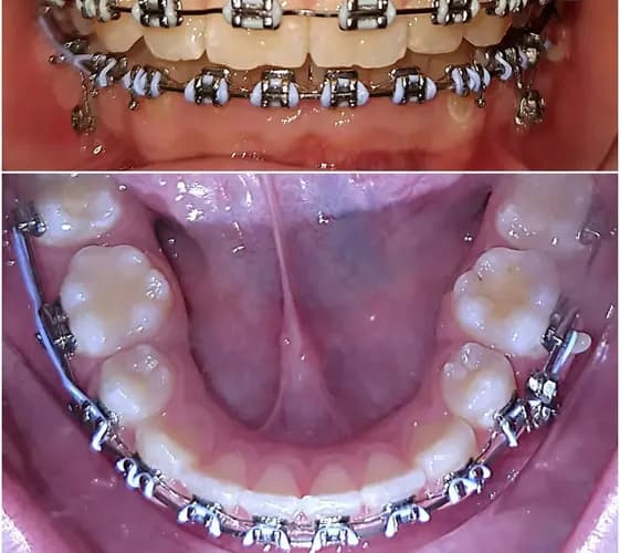 Встановлення брекетів для вирівнювання зубів у Варшаві