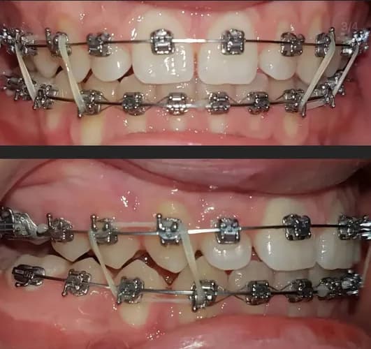 Встановлення брекетів для вирівнювання зубів у Варшаві