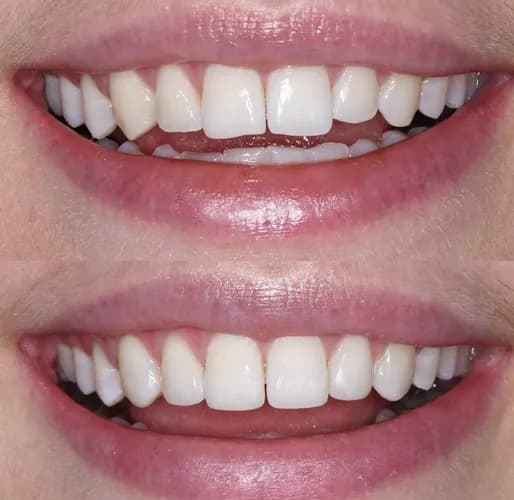 Uszkodzone przednie zęby estetyczna odbudowa kompozytowa Warszawa