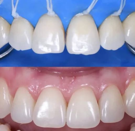 Uszkodzone przednie zęby estetyczna odbudowa kompozytowa Warszawa