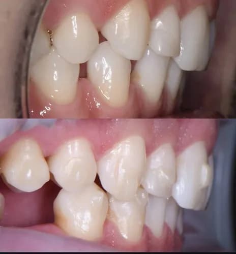 Wada zgryzu leczenie aparatem ortodontycznym (brakiety) Warszawa