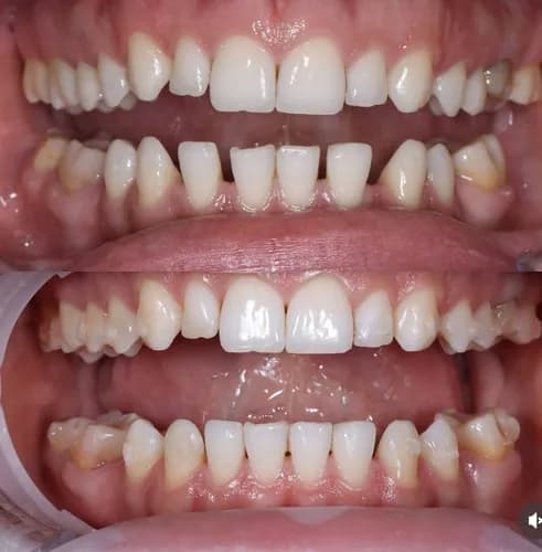 Wada zgryzu leczenie aparatem ortodontycznym (brakiety) Warszawa