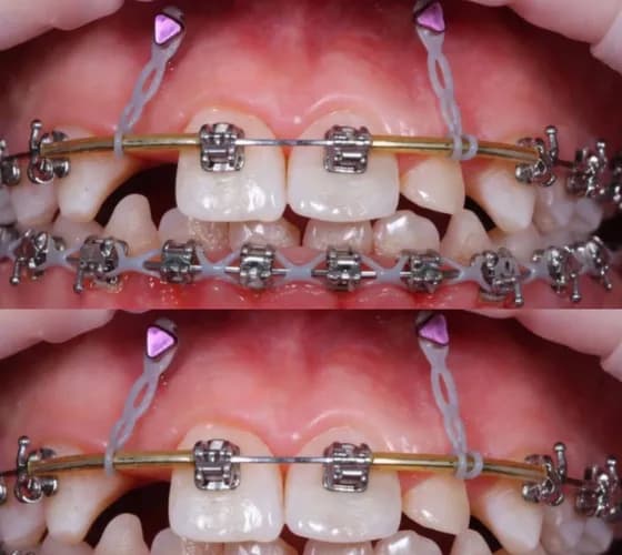 Wada zgryzu leczenie aparatem ortodontycznym (brakiety) Warszawa