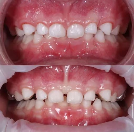 Wada zgryzu u dziecka leczenie ortodontyczne dzieci Warszawa