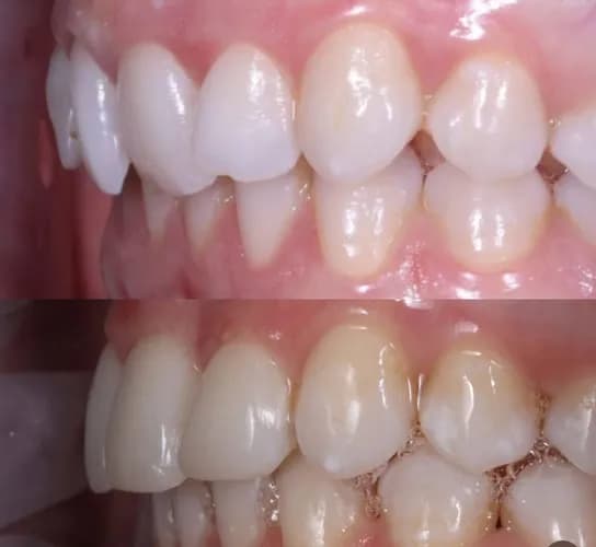 Nierówny zgryz leczenie alignerami (nakładkami) Warszawa