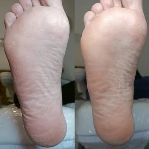 Pedicure dla problematycznych paznokci i stóp