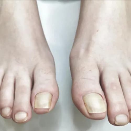 Педикюр с лечебным эффектом