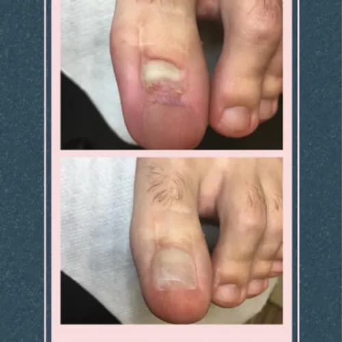 Pedicure na problematyczne stopy i paznokcie