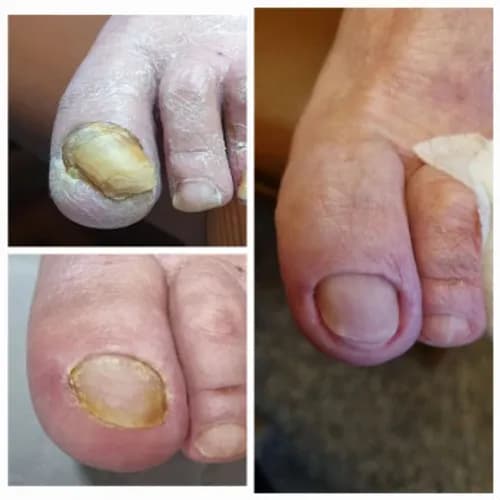 Pedicure leczniczy, wykonywany przez mistrzów z wykształceniem medycznym.
