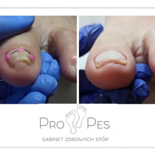 Pedicure estetyczny z ukierunkowaniem medycznym
