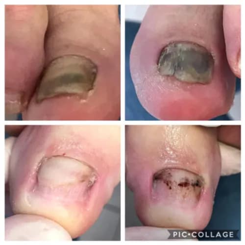 Pedicure zwalczający odciski
