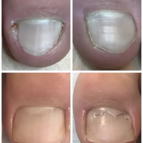 Восстановление ногтя шаг за шагом