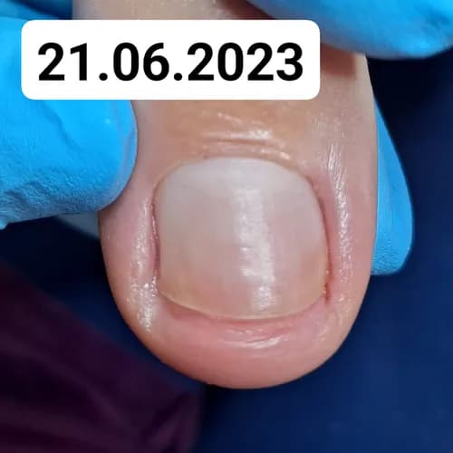 Profesjonalna pomoc dla zniszczonych paznokci
