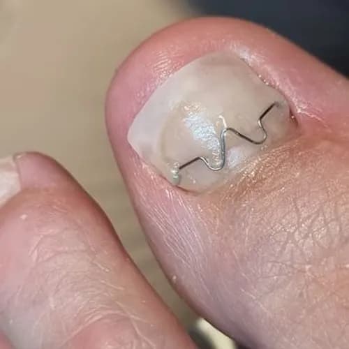 Ремонт нігтів після пошкоджень