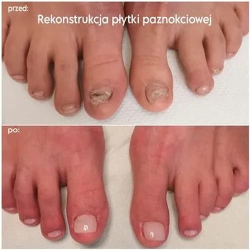 Protetyczne techniki dla estetycznych paznokci