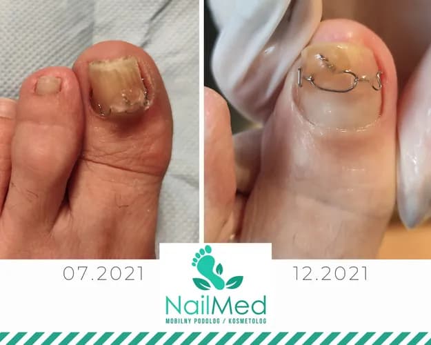 Реконструкция ногтей в сложных ситуациях