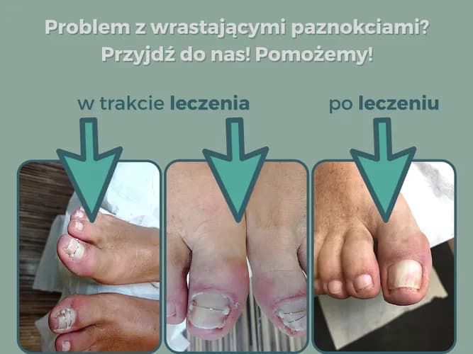 Naprawa paznokci w każdym stanie