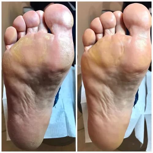 Zdrowa skóra pięt w każdym wieku