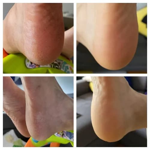 Peeling pięt dla zdrowej skóry