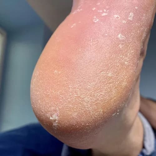 Профессиональная чистка стоп и пяток