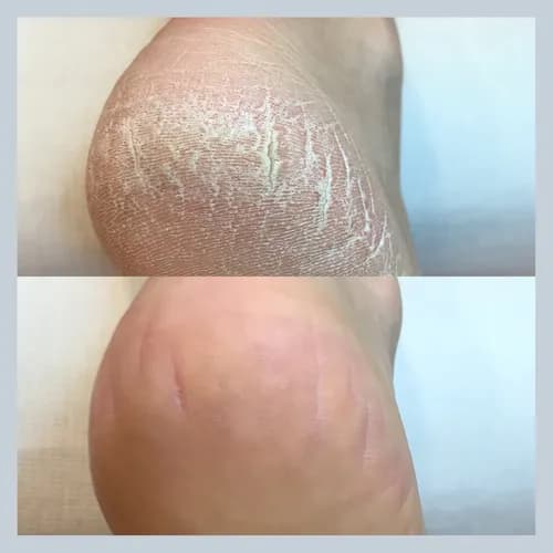 Профессиональный уход за пятками в нашем салоне