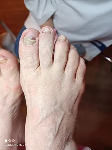 Помогаю лечить грибок ногтей