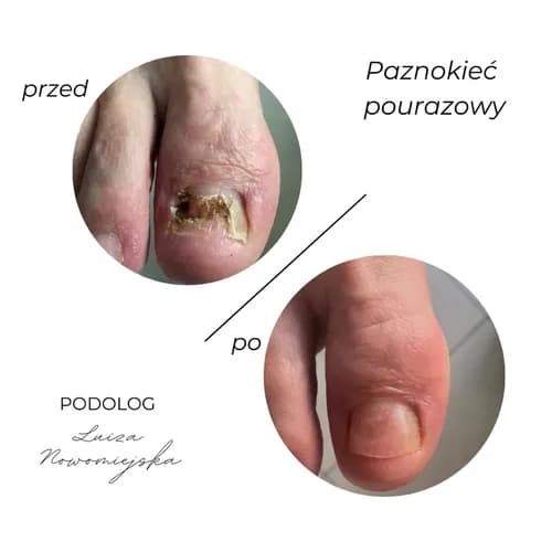 Безопасные методы лечения грибка