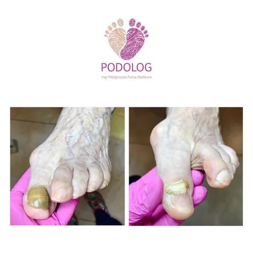 Профессиональная борьба с грибком ногтей