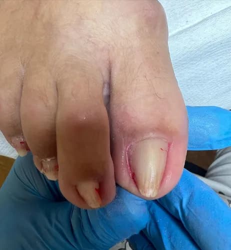 Чистка ногтей от грибка у меня