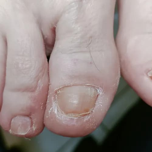 Натуральные методы лечения грибка у меня