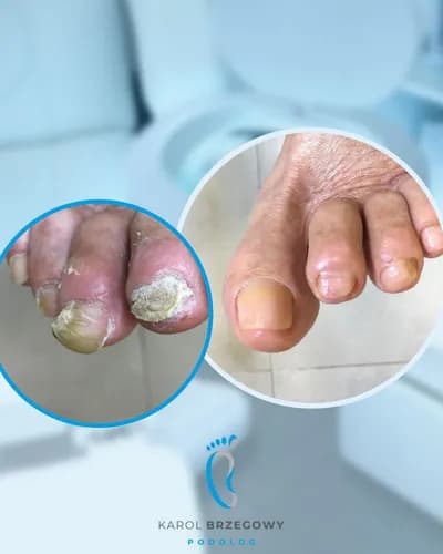 Лечение грибка в комфортных условиях