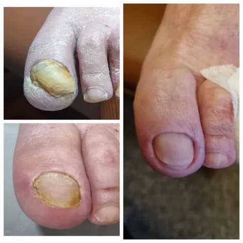 Leczenie grzybicy paznokci w nowoczesnym salonie