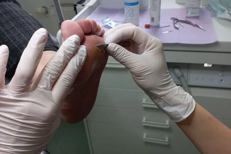 Удаление натоптышей в салоне красоты