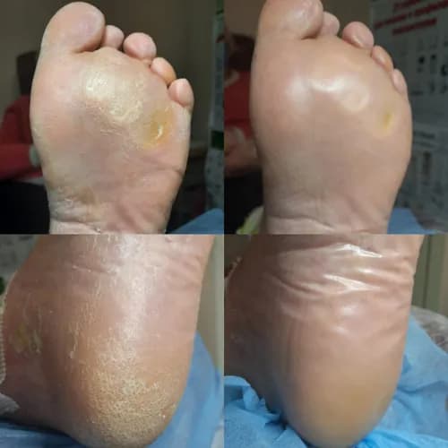 Profesjonalne usuwanie zrogowaceń