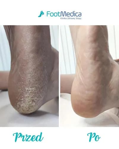 Piękne stopy bez natoptyków