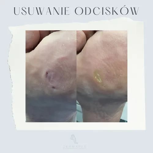 Специализированное удаление натоптышей в салоне