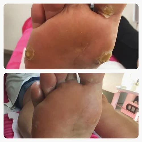 Здоровые и красивые стопы без мозолей