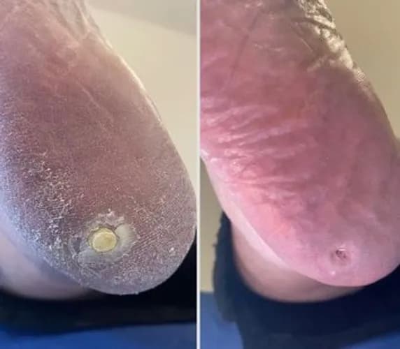 Комплексный уход за стопами без мозолей