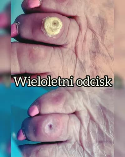 Nowoczesne metody usuwania odcisków