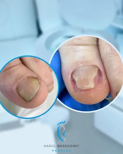 Twój osobisty ekspert od onycholizy