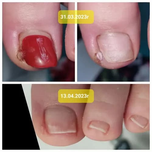 Terapia paznokci w najlepszym wydaniu