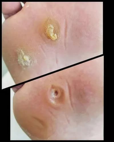 Бородавки? Я помогу их удалить!