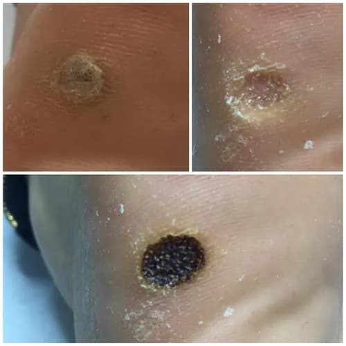 Эксперт в удалении бородавок