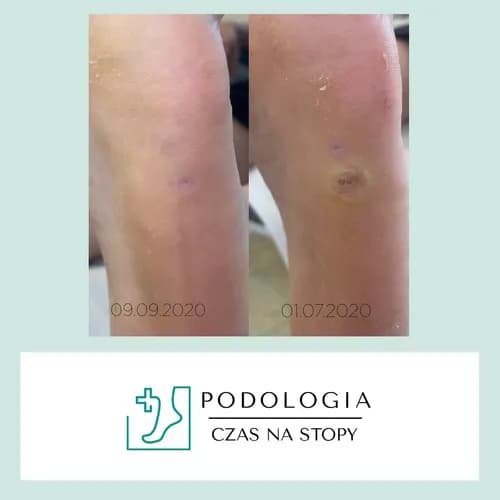 Specjaliści od leczenia brodawek na stopach