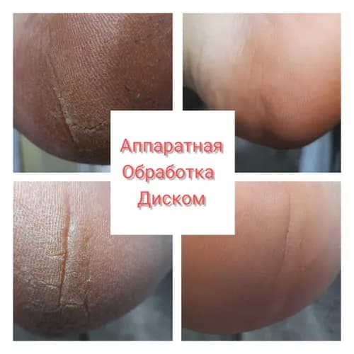 Лікування тріщин на п'ятах